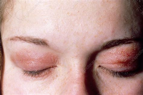 eye makeup allergy